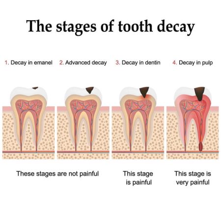 What do Cavities Look like:Early Signs And Symptoms