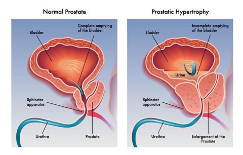 prevent prostate problems