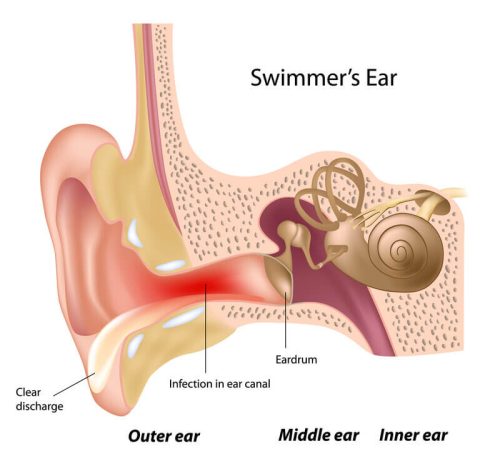 Swimmer's Ear tinnitus